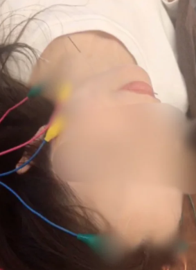 電気を流す美容鍼